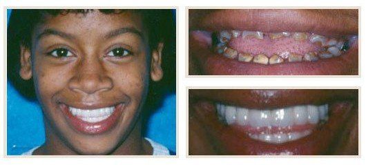 before and after - patient 13