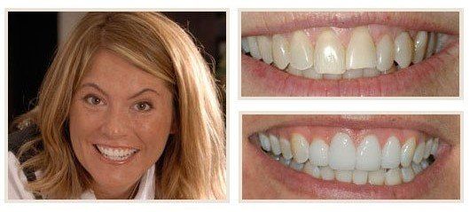 before and after - patient 12