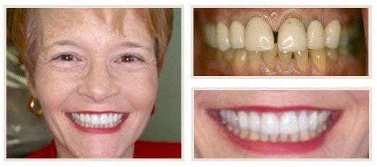 before and after - patient 14