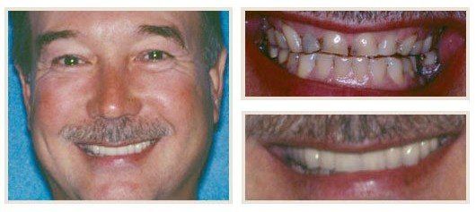 before and after - patient 18