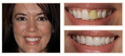 before and after - patient 15