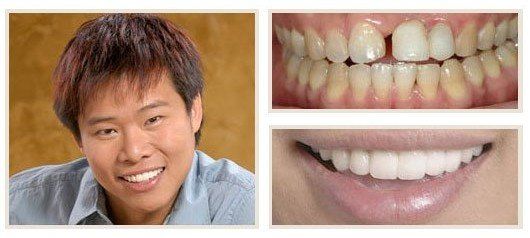 before and after - patient 16