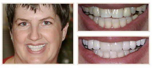 before and after - patient 20