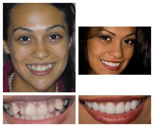 before and after - patient 1
