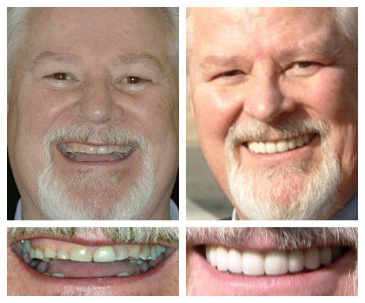before and after - patient 2