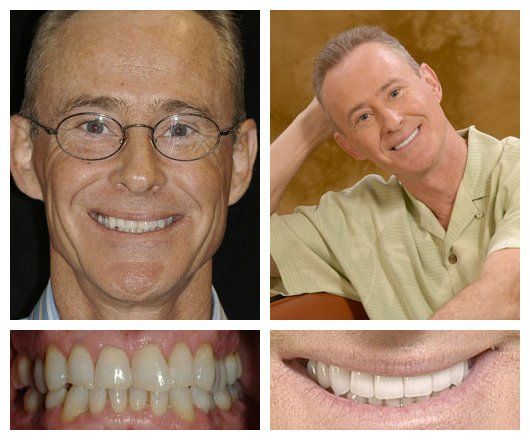 before and after - patient 4