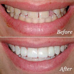 before and after dental bridges