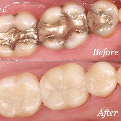 dental crowns before and after