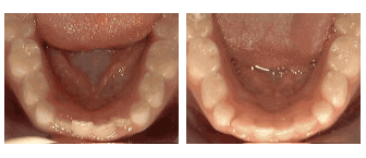 Non-braces treatment - before and after