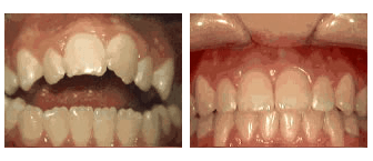 open bite - before and after