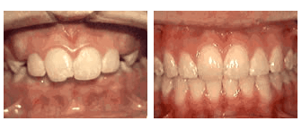 Overjet - before and after