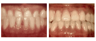 Underbite - before and after