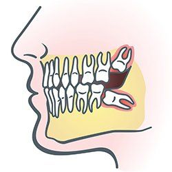 Wisdom teeth illustration