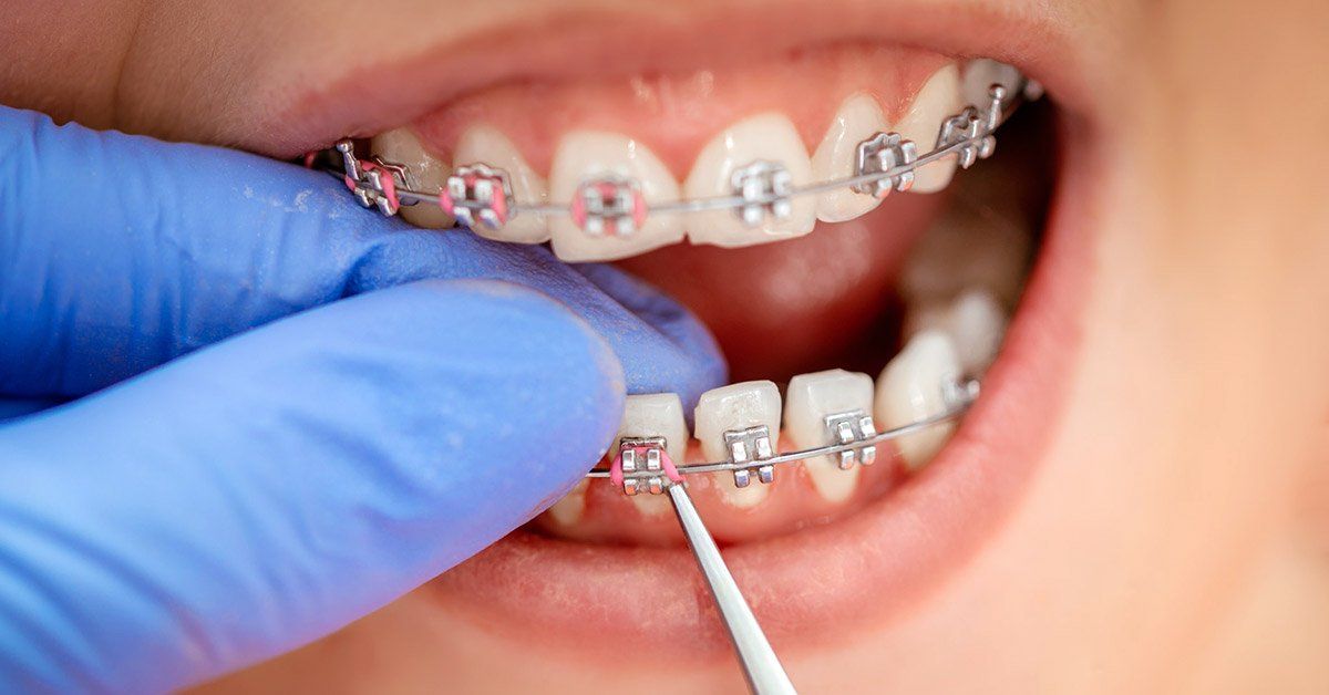orthodontic treatment