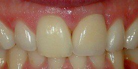 Teeth after Single Tooth Replacement