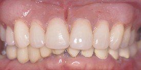Teeth After Upper Arch Replacement