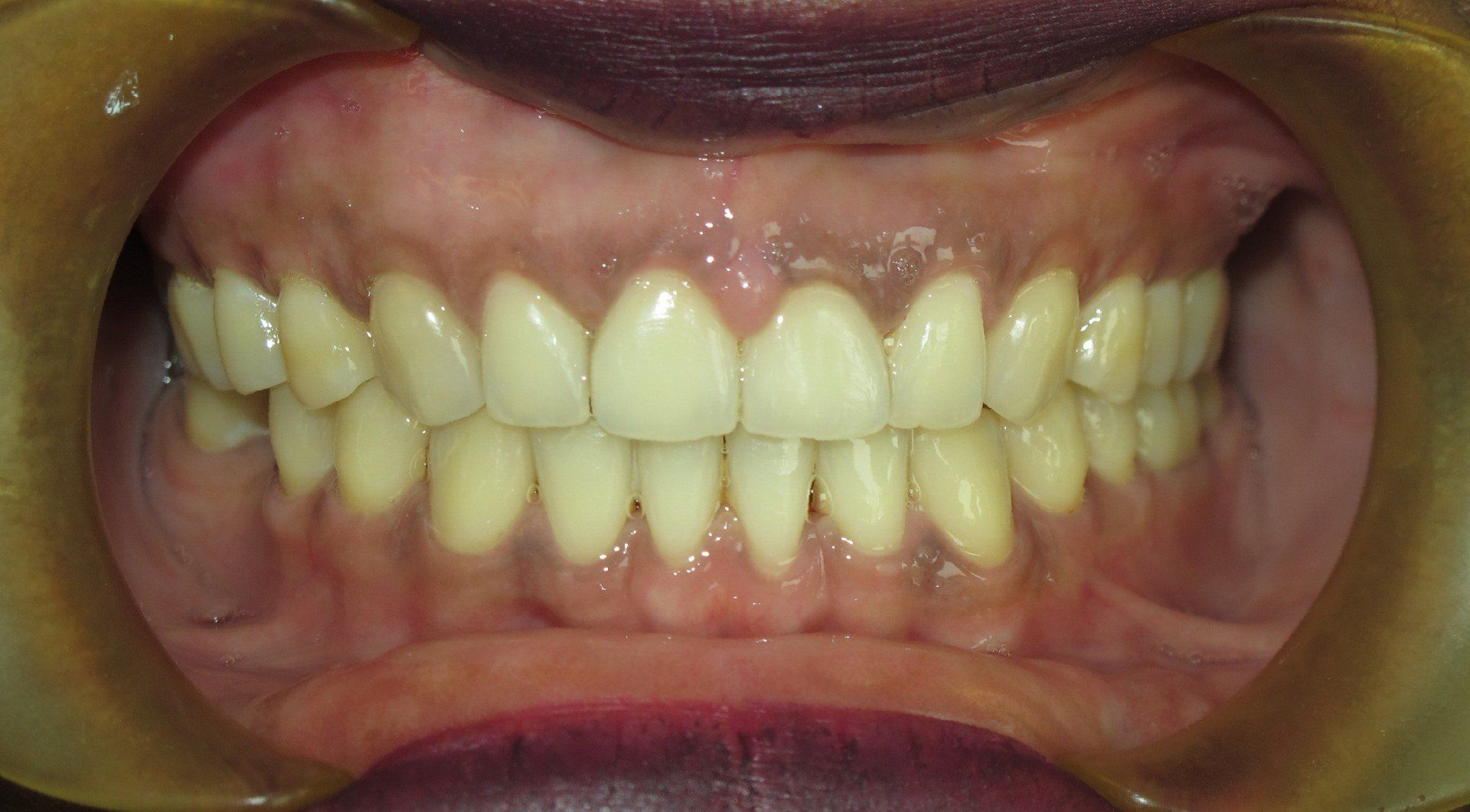 Clinical Treatment Case By Dr. Ziad Omar, City Centre Orthodontics in Mississauga & Bolton