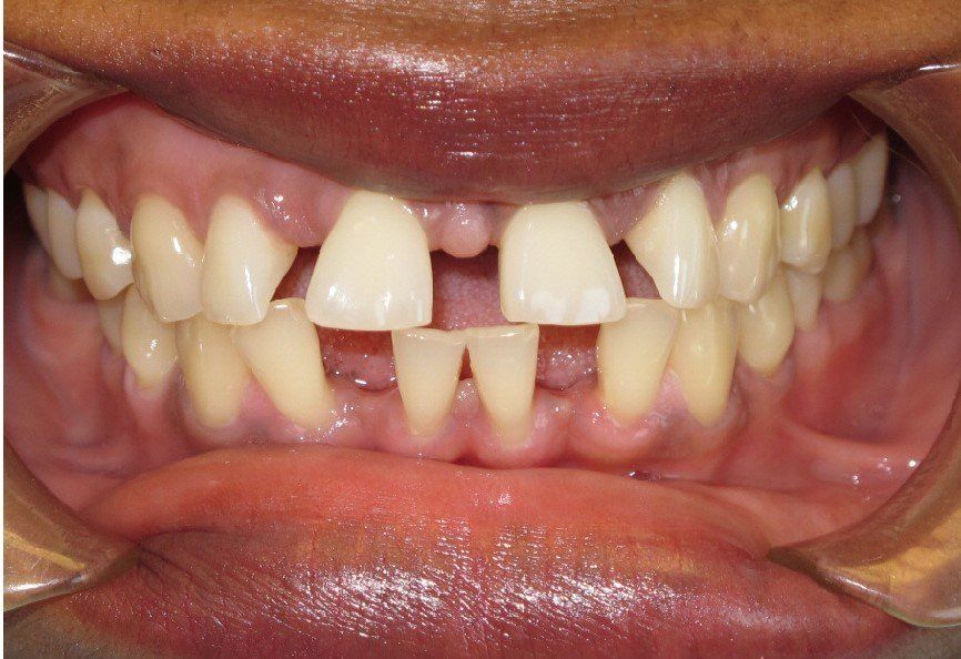 Clinical Treatment Case By Dr. Ziad Omar, City Centre Orthodontics in Mississauga & Bolton