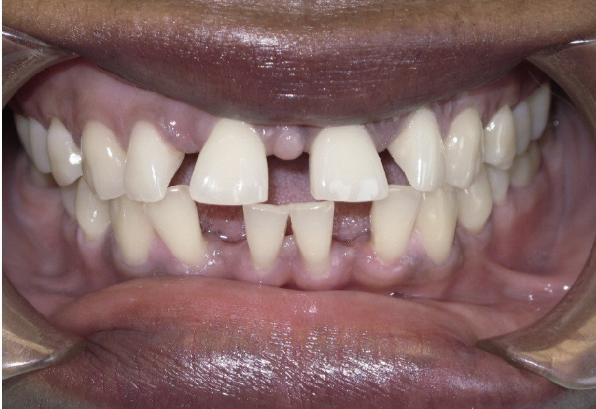 Clinical Treatment Case By Dr. Ziad Omar, City Centre Orthodontics in Mississauga & Bolton