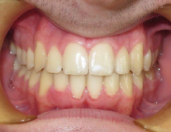 Clinical Treatment Case By Dr. Ziad Omar, City Centre Orthodontics in Mississauga & Bolton