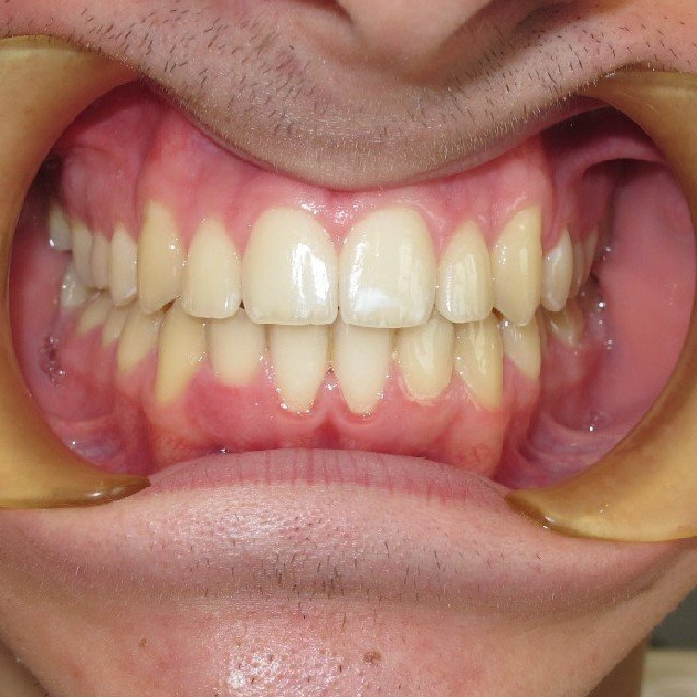 Clinical Treatment Case By Dr. Ziad Omar, City Centre Orthodontics in Mississauga & Bolton