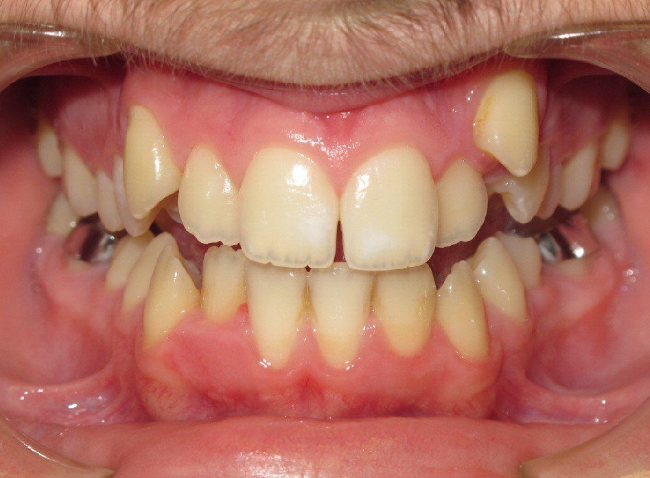 Clinical Treatment Case By Dr. Ziad Omar, City Centre Orthodontics in Mississauga & Bolton