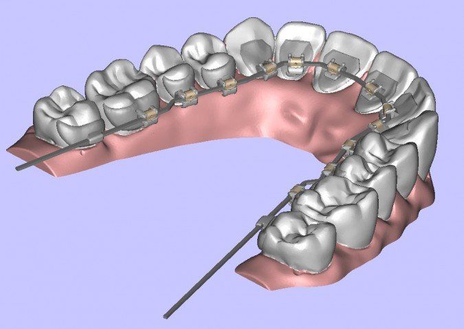 Harmony-Inside Braces