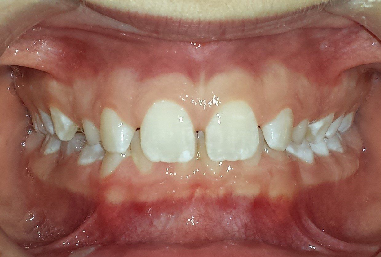 Clinical Treatment Case By Dr. Ziad Omar, City Centre Orthodontics in Mississauga & Bolton