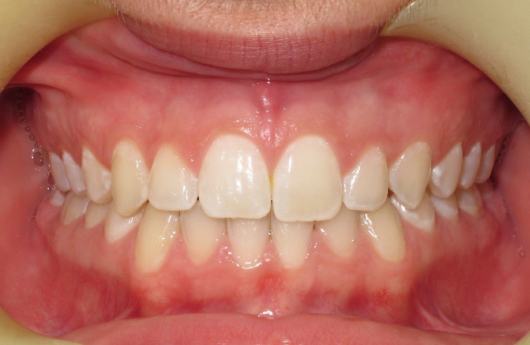 Clinical Treatment Case By Dr. Ziad Omar, City Centre Orthodontics in Mississauga & Bolton