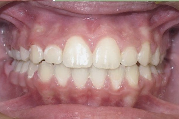 Clinical Treatment Case By Dr. Ziad Omar, City Centre Orthodontics in Mississauga & Bolton