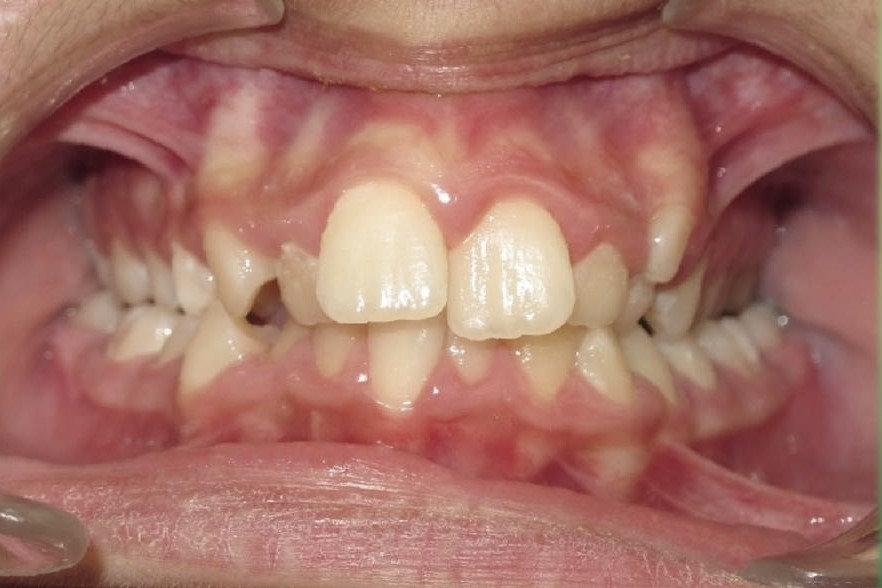 Clinical Treatment Case By Dr. Ziad Omar, City Centre Orthodontics in Mississauga & Bolton