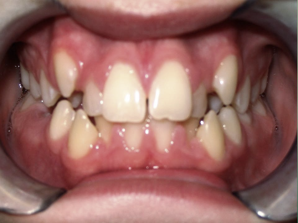 Clinical Treatment Case By Dr. Ziad Omar, City Centre Orthodontics in Mississauga & Bolton