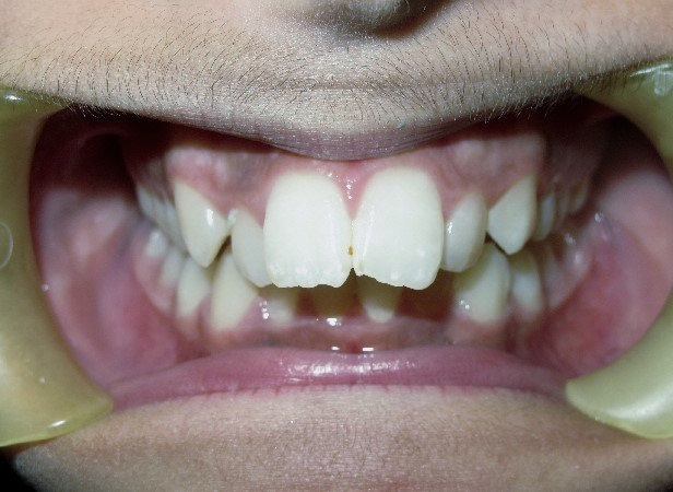 Clinical Treatment Case By Dr. Ziad Omar, City Centre Orthodontics in Mississauga & Bolton
