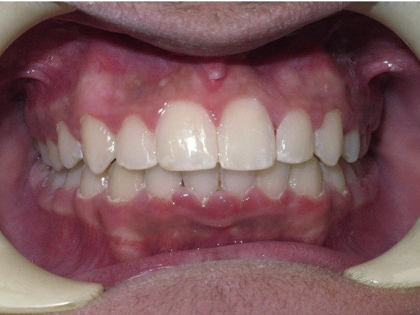 Clinical Treatment Case By Dr. Ziad Omar, City Centre Orthodontics in Mississauga & Bolton