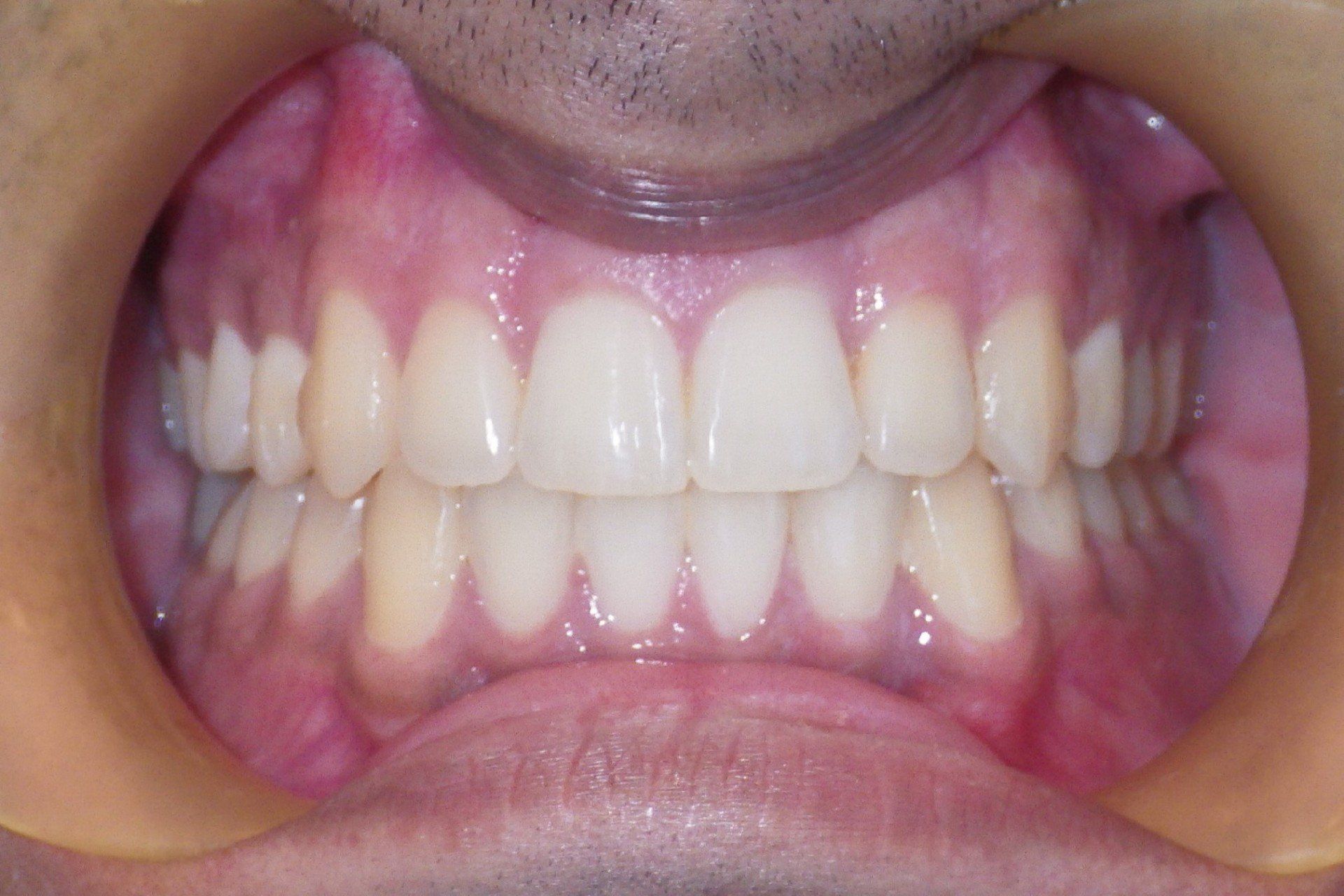 Clinical Treatment Case By Dr. Ziad Omar, City Centre Orthodontics in Mississauga & Bolton