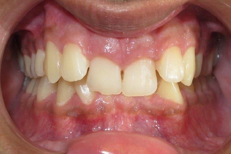 Clinical Treatment Case By Dr. Ziad Omar, City Centre Orthodontics in Mississauga & Bolton