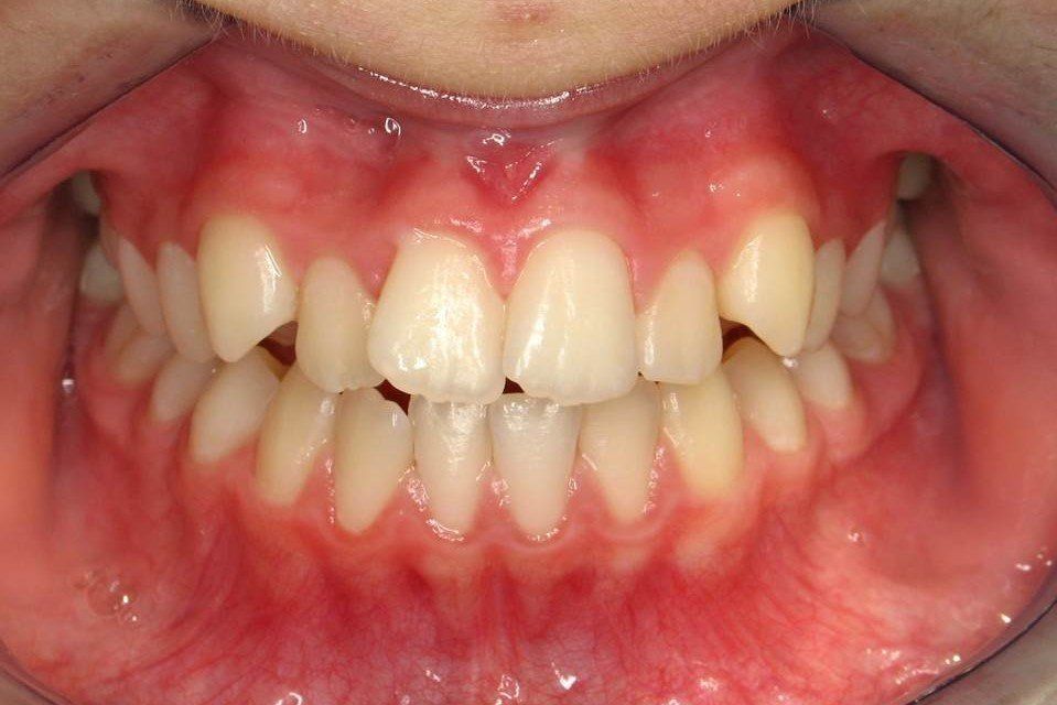 Clinical Treatment Case By Dr. Ziad Omar, City Centre Orthodontics in Mississauga & Bolton