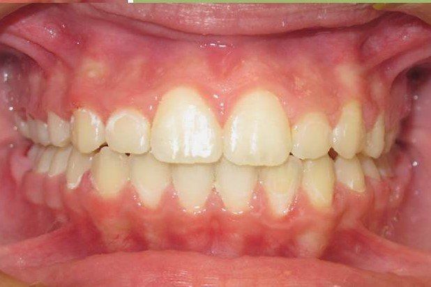 Clinical Treatment Case By Dr. Ziad Omar, City Centre Orthodontics in Mississauga & Bolton