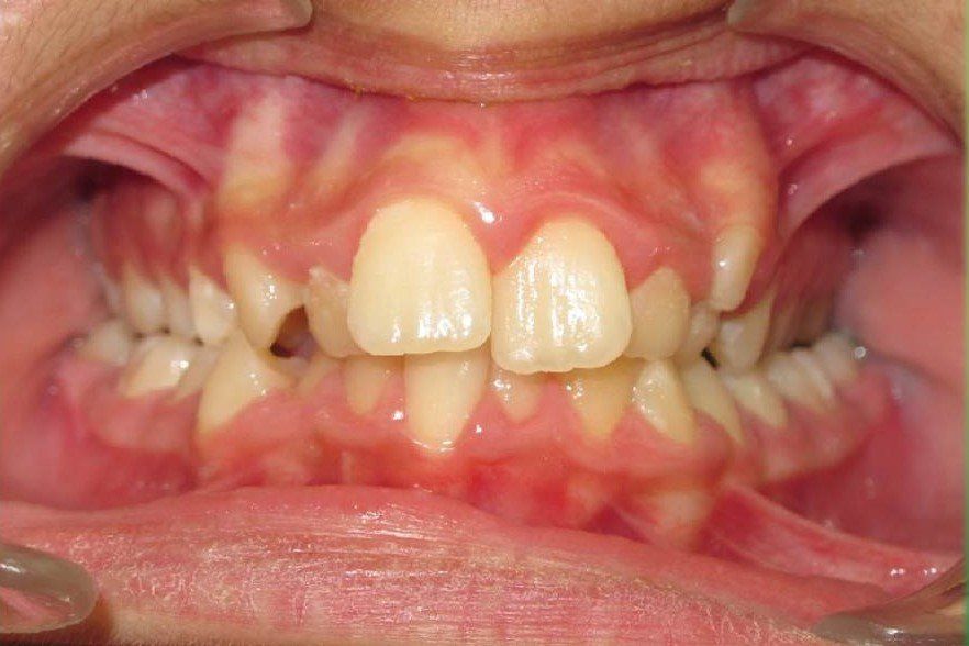 Clinical Treatment Case By Dr. Ziad Omar, City Centre Orthodontics in Mississauga & Bolton