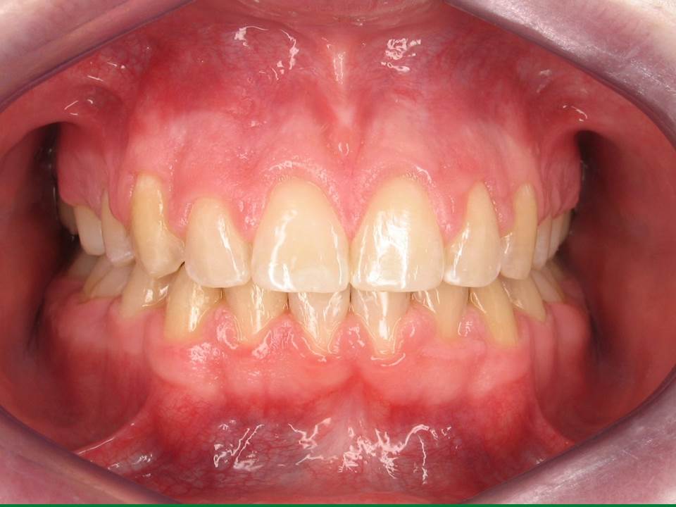 Clinical Treatment Case By Dr. Ziad Omar, City Centre Orthodontics in Mississauga & Bolton