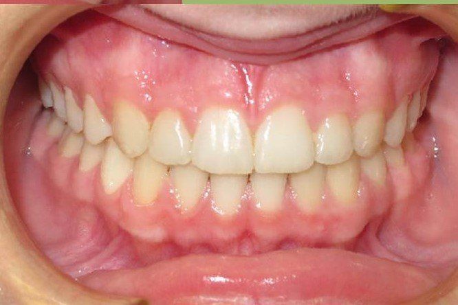 Clinical Treatment Case By Dr. Ziad Omar, City Centre Orthodontics in Mississauga & Bolton