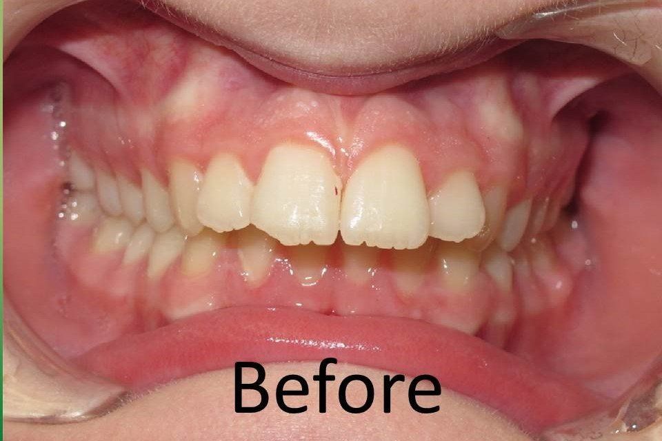 Clinical Treatment Case By Dr. Ziad Omar, City Centre Orthodontics in Mississauga & Bolton