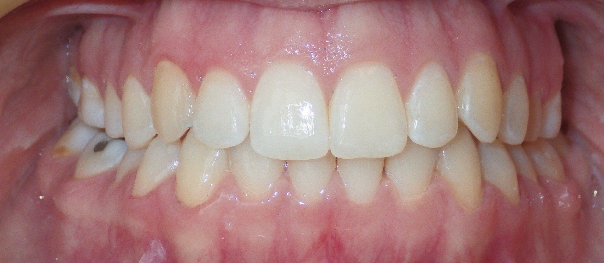 Clinical Treatment Case By Dr. Ziad Omar, City Centre Orthodontics in Mississauga & Bolton