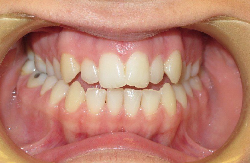 Clinical Treatment Case By Dr. Ziad Omar, City Centre Orthodontics in Mississauga & Bolton