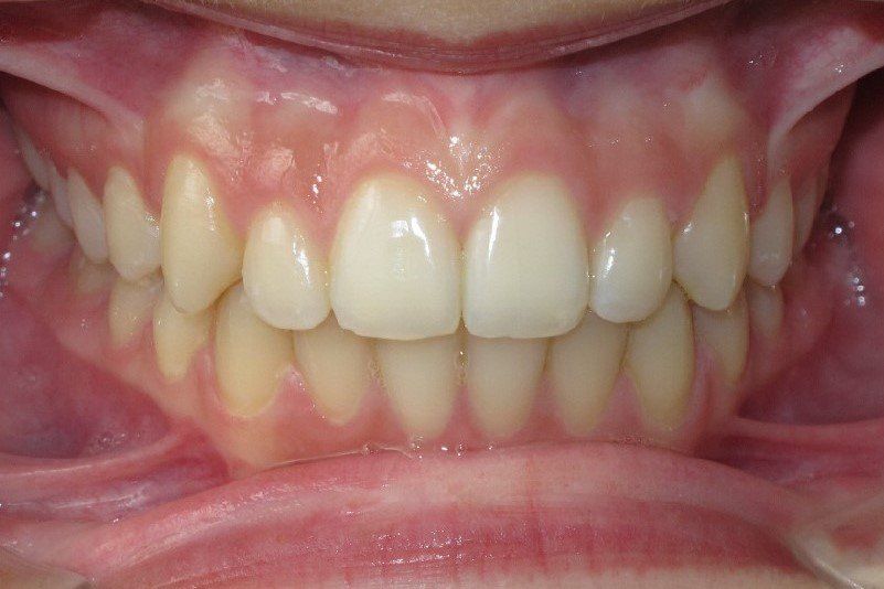 Clinical Treatment Case By Dr. Ziad Omar, City Centre Orthodontics in Mississauga & Bolton