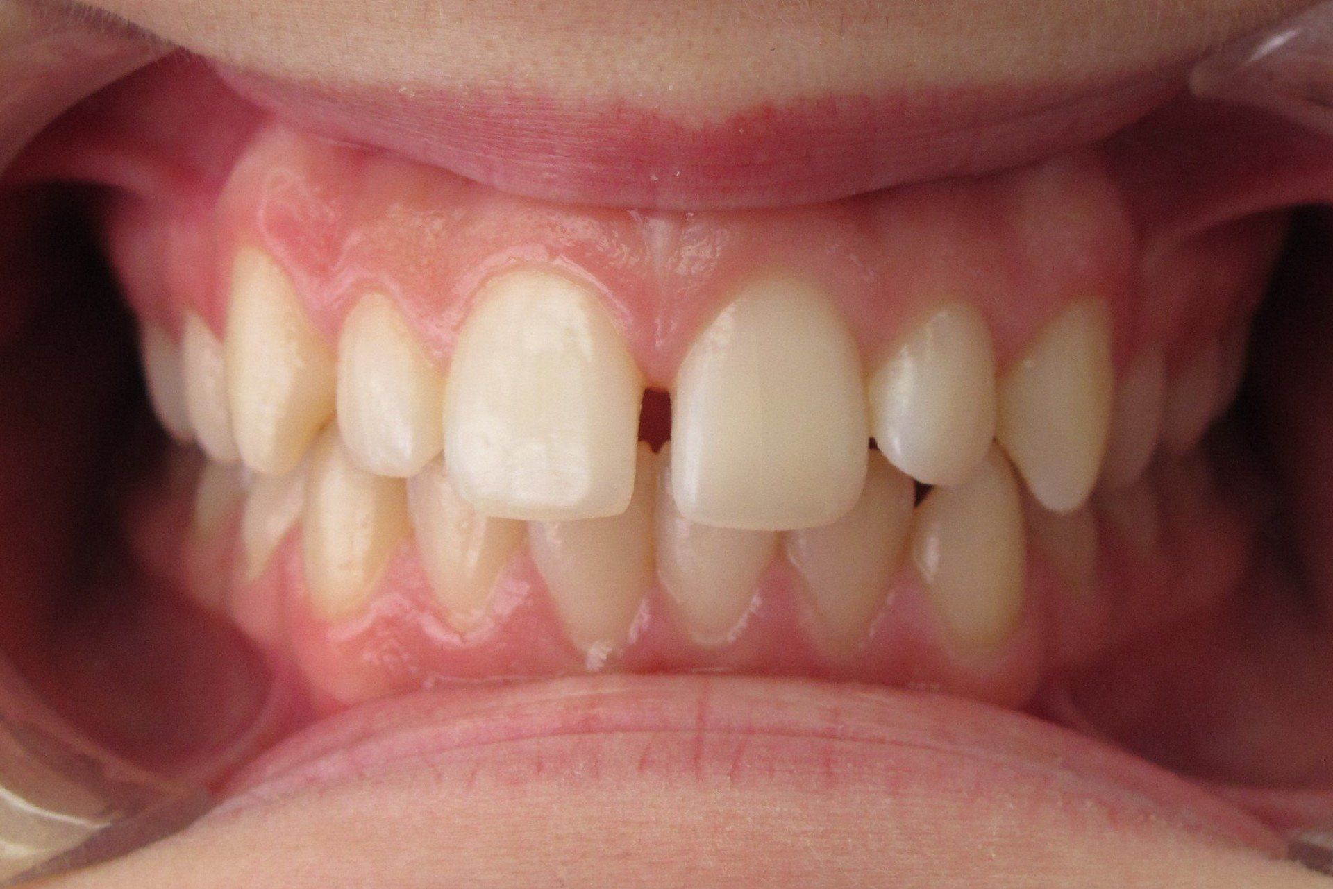 Clinical Treatment Case By Dr. Ziad Omar, City Centre Orthodontics in Mississauga & Bolton