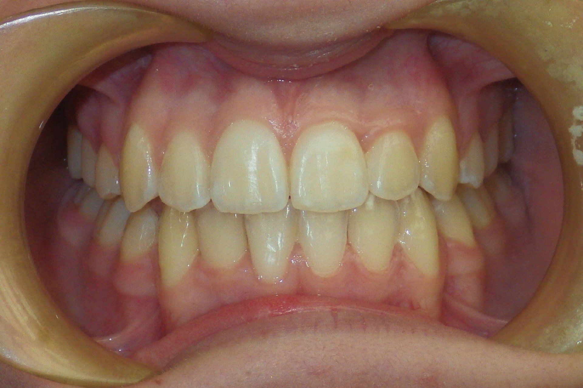 Clinical Treatment Case By Dr. Ziad Omar, City Centre Orthodontics in Mississauga & Bolton