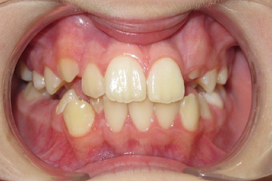 Clinical Treatment Case By Dr. Ziad Omar, City Centre Orthodontics in Mississauga & Bolton