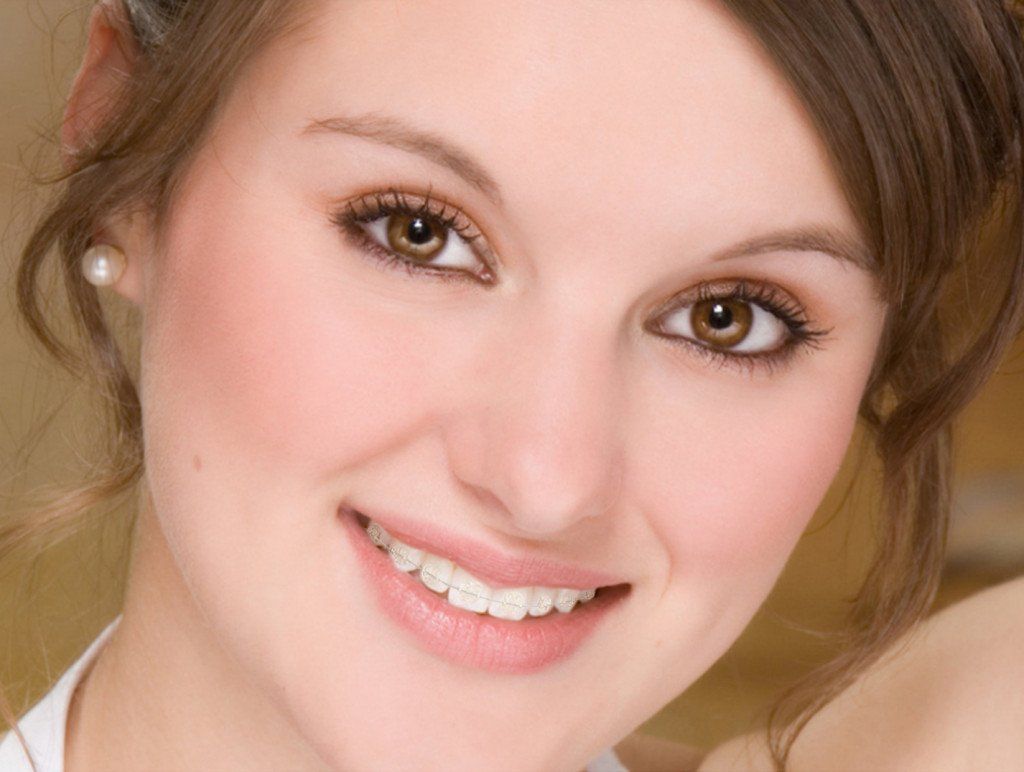 Radiance Clear Braces