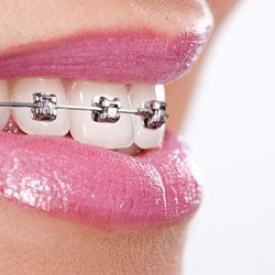 braces